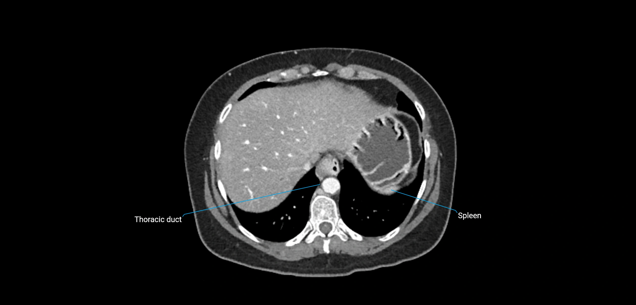 CT ct abdominal lymph nodes  axial cross sectional anatomy  enchanced radiology image -img-00002-00079.webp